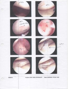 03-08-10_Right Knee Orthoscopy photo